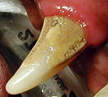 Stage II Periodontal disease