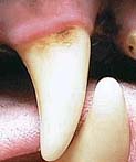 Stage I Periodontal Disease - Example 1