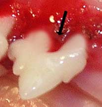 Stage IV Periodontal disease: