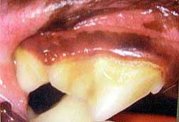 Stage I Periodontal Disease - Example 2