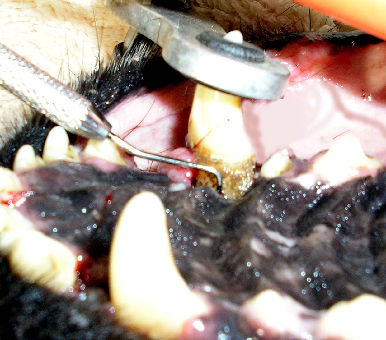 Stage IV Periodontal disease: