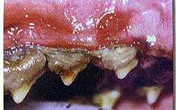 Stage IV Periodontal disease: